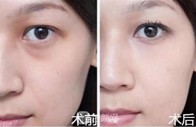 重慶當(dāng)代整形醫(yī)院自體脂肪填充照真人案例