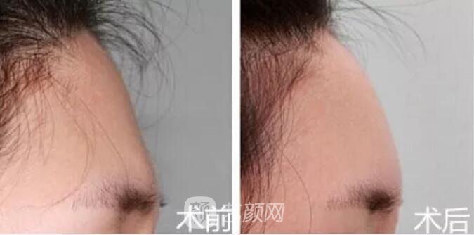 重慶當(dāng)代整形醫(yī)院自體脂肪填充照真人案例