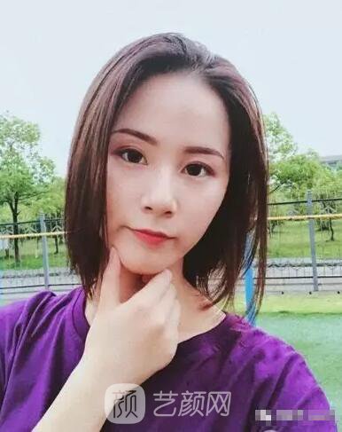 北京上上相鄭楚蓉院長(zhǎng)自體脂肪填充全臉圖心情小記