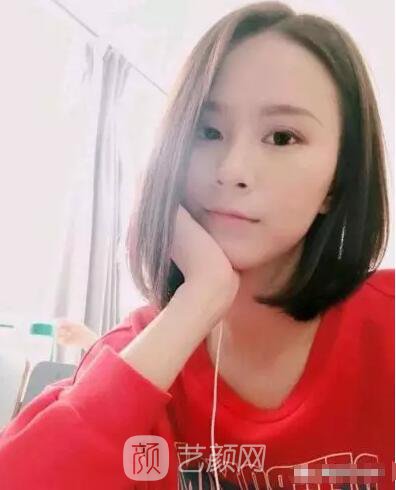 北京上上相鄭楚蓉院長(zhǎng)自體脂肪填充全臉圖心情小記