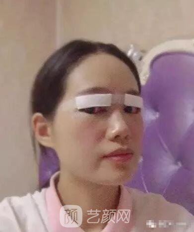 王紅敏切開(kāi)雙眼皮+開(kāi)內(nèi)眼角圖術(shù)后心情小述
