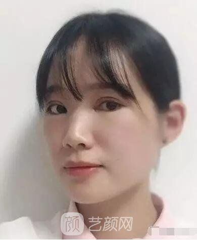 王紅敏切開(kāi)雙眼皮+開(kāi)內(nèi)眼角圖術(shù)后心情小述