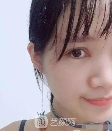 王紅敏切開(kāi)雙眼皮+開(kāi)內(nèi)眼角圖術(shù)后心情小述