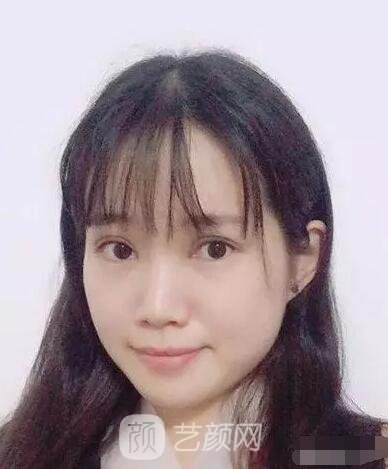 王紅敏切開(kāi)雙眼皮+開(kāi)內(nèi)眼角圖術(shù)后心情小述