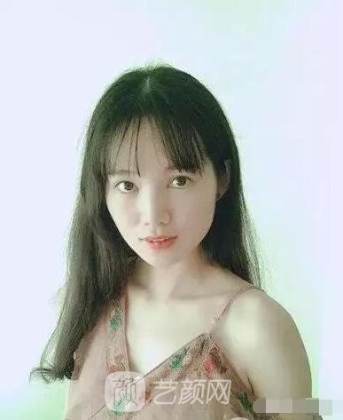 王紅敏切開(kāi)雙眼皮+開(kāi)內(nèi)眼角圖術(shù)后心情小述