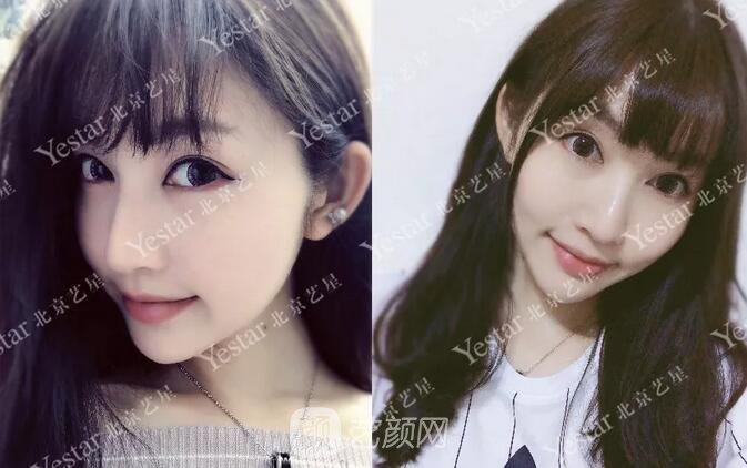 北京藝星整形醫(yī)院注射瘦臉￥499 | 打完半個(gè)月，來看看果!