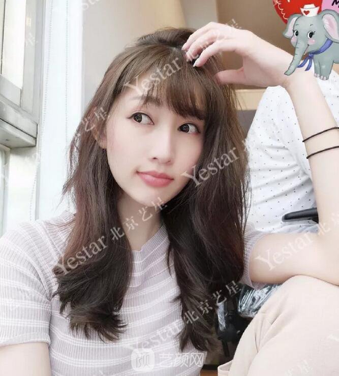 北京藝星整形醫(yī)院注射瘦臉￥499 | 打完半個(gè)月，來看看果!