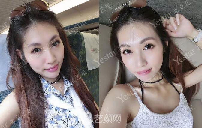 北京藝星整形醫(yī)院注射瘦臉￥499 | 打完半個(gè)月，來看看果!