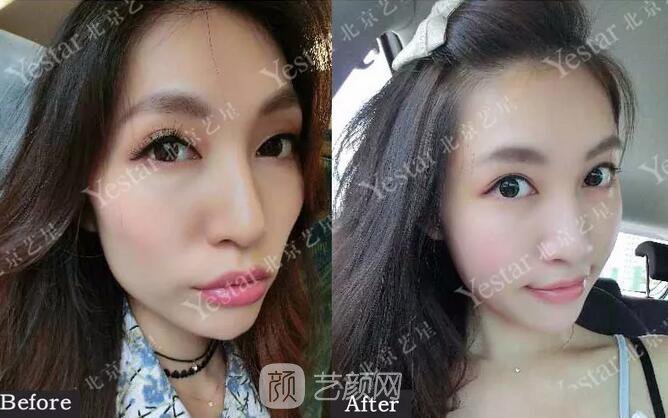 北京藝星整形醫(yī)院注射瘦臉￥499 | 打完半個(gè)月，來看看果!