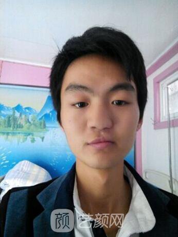 熊清華唇腭裂整形修復(fù)案例照片