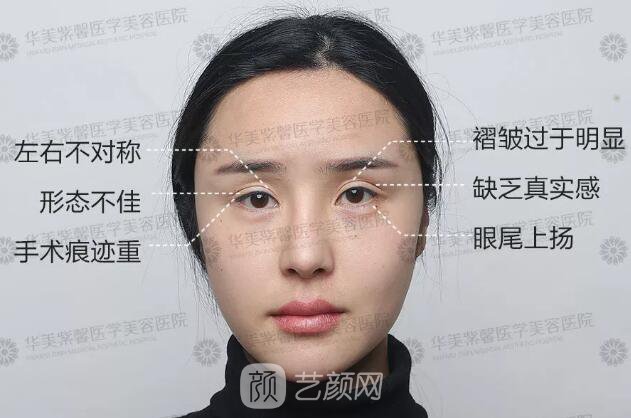 華美紫馨雙眼皮失敗修復(fù)圖純分享案例