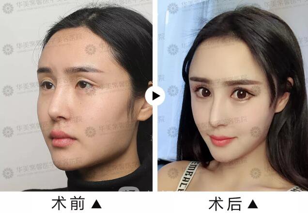 華美紫馨雙眼皮失敗修復(fù)圖純分享案例