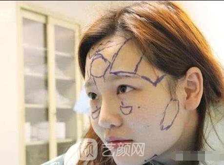 艾紅梅面部自體脂肪填充手術(shù)圖心情分享