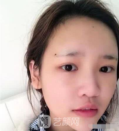 艾紅梅面部自體脂肪填充手術(shù)圖心情分享