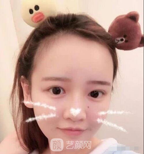 艾紅梅面部自體脂肪填充手術(shù)圖心情分享