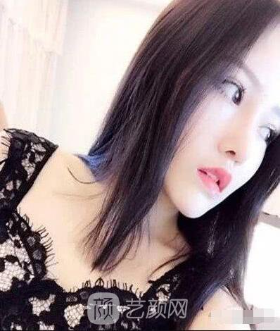 艾紅梅面部自體脂肪填充手術(shù)圖心情分享