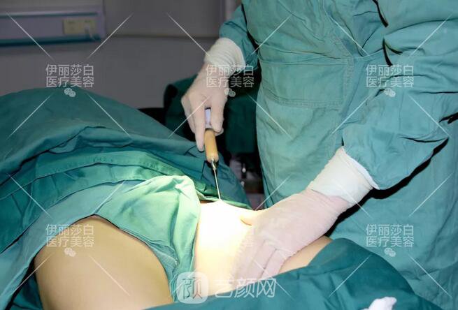 惠州伊麗莎白整形醫(yī)院自體脂肪豐胸圖 豐胸圖鑒