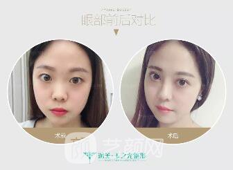 成都玉之光雙眼皮案例