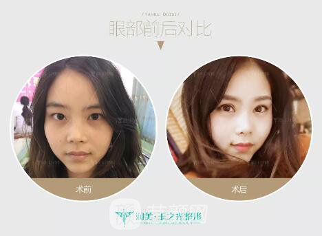 成都玉之光雙眼皮案例