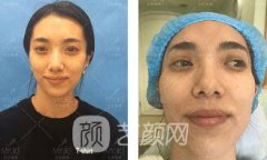 肖瑋玻尿酸填充太陽穴果圖+注射照片分享~