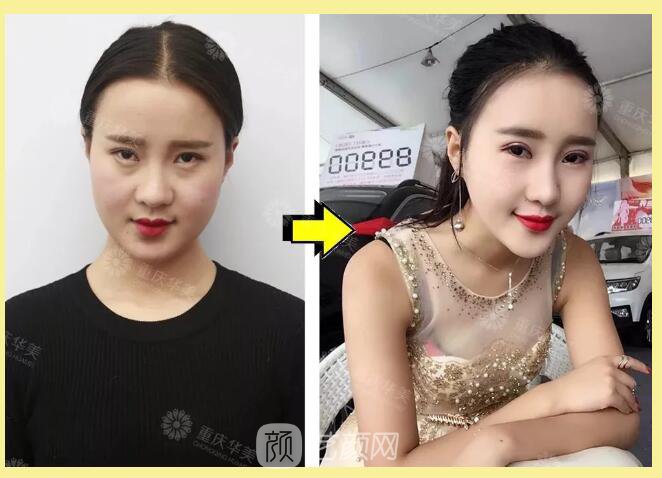 重慶華美整形【雙11今日開搶】14款醫(yī)美尖貨更低11元，驚爆特價!保價!