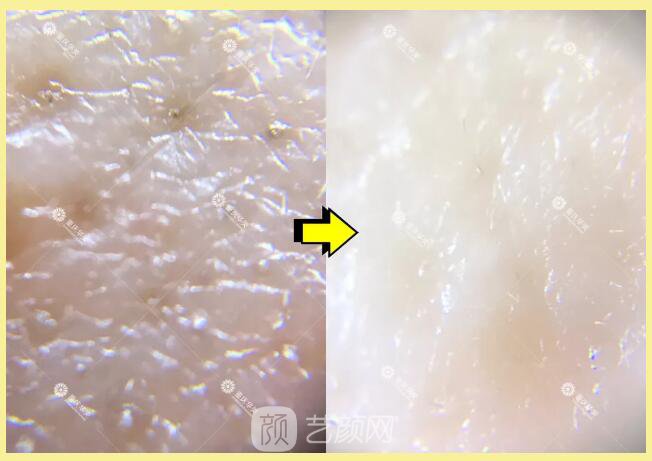 重慶華美整形【雙11今日開搶】14款醫(yī)美尖貨更低11元，驚爆特價!保價!