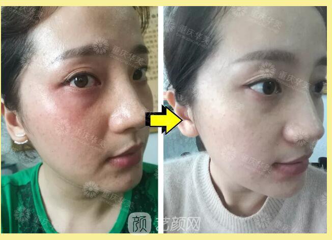 重慶華美整形【雙11今日開搶】14款醫(yī)美尖貨更低11元，驚爆特價!保價!