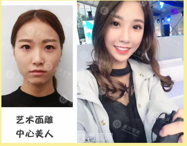 重慶華美整形【雙11今日開搶】14款醫(yī)美尖貨更低11元，驚爆特價!保價!