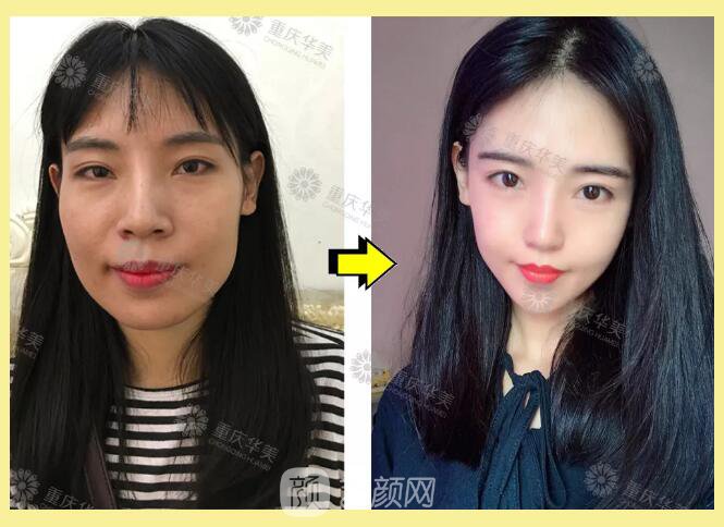 重慶華美整形【雙11今日開搶】14款醫(yī)美尖貨更低11元，驚爆特價!保價!