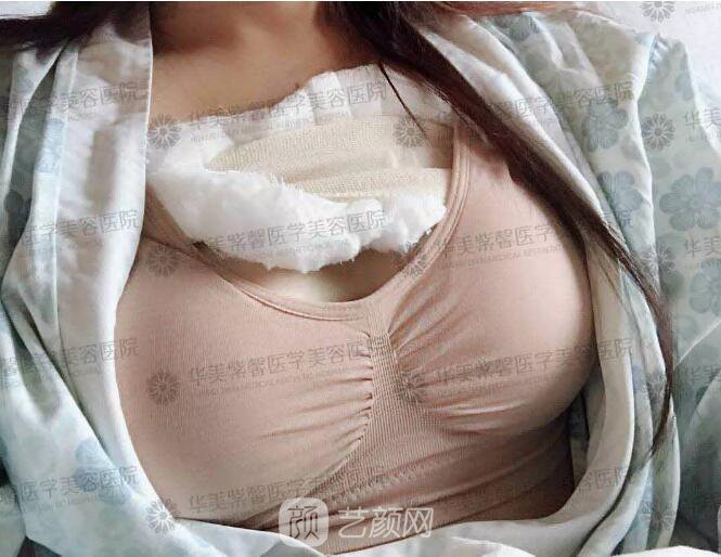 華美紫馨整形醫(yī)院謝凱英假體豐胸圖 真人案例分享哦~