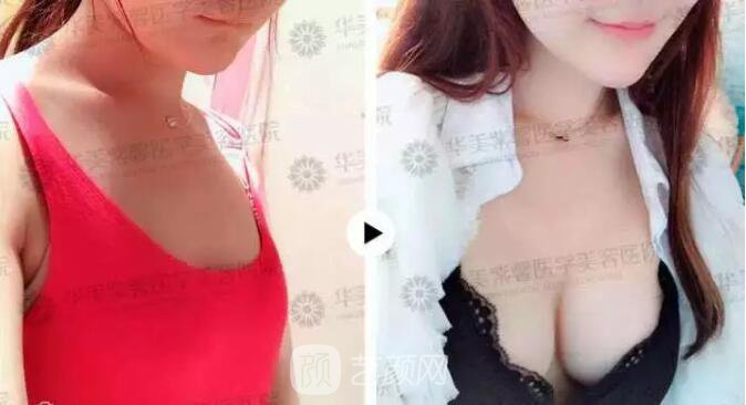 華美紫馨整形醫(yī)院謝凱英假體豐胸圖 真人案例分享哦~