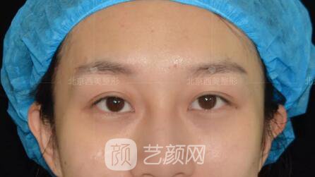 北京西美整形全切雙眼皮，徹底拯救我的大小眼