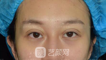 北京西美整形全切雙眼皮，徹底拯救我的大小眼