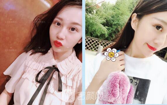 北京西美整形全切雙眼皮，徹底拯救我的大小眼