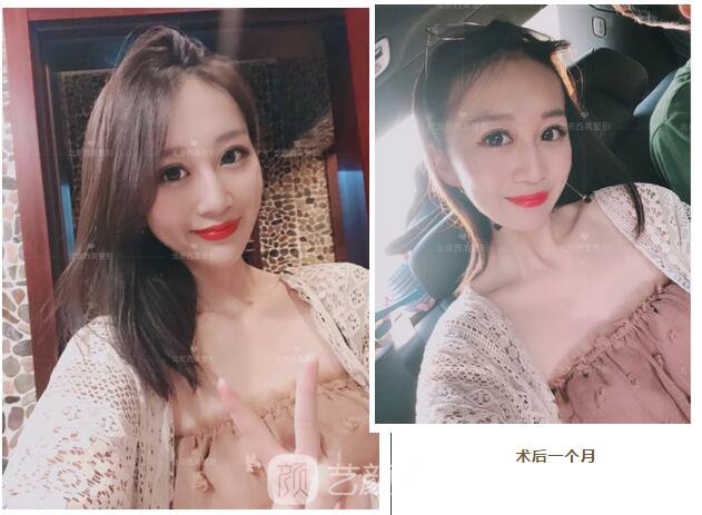 北京西美整形全切雙眼皮，徹底拯救我的大小眼