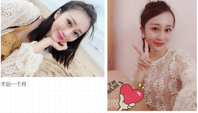 北京西美整形全切雙眼皮，徹底拯救我的大小眼