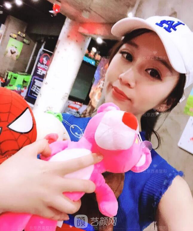 北京西美整形全切雙眼皮，徹底拯救我的大小眼