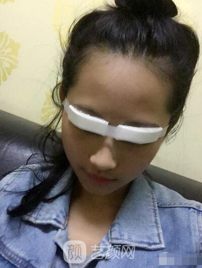 萍鄉(xiāng)優(yōu)美整形李清芳全切雙眼皮照片 拯救眼睛不對稱