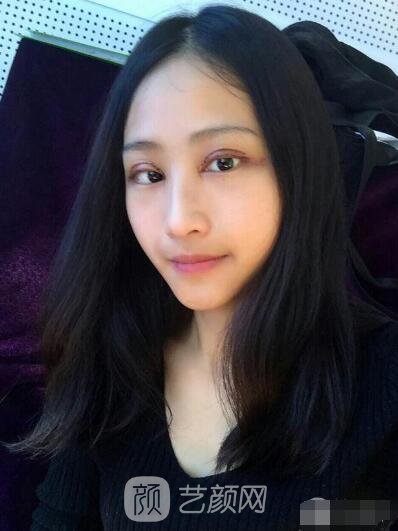 萍鄉(xiāng)優(yōu)美整形李清芳全切雙眼皮照片 拯救眼睛不對稱