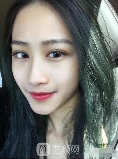 萍鄉(xiāng)優(yōu)美整形李清芳全切雙眼皮照片 拯救眼睛不對稱