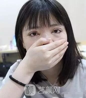 上海伊美爾港華醫(yī)院開雙眼皮圖 大小眼的救星