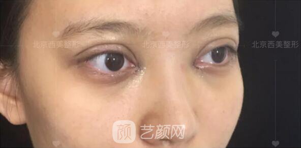 北京西美整形醫(yī)院全切雙眼皮真人案例圖|內(nèi)附恢復(fù)過(guò)程哦~