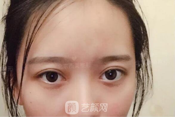 北京西美整形醫(yī)院全切雙眼皮真人案例圖|內(nèi)附恢復(fù)過(guò)程哦~