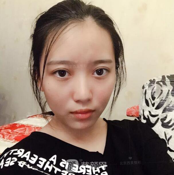 北京西美整形醫(yī)院全切雙眼皮真人案例圖|內(nèi)附恢復(fù)過(guò)程哦~
