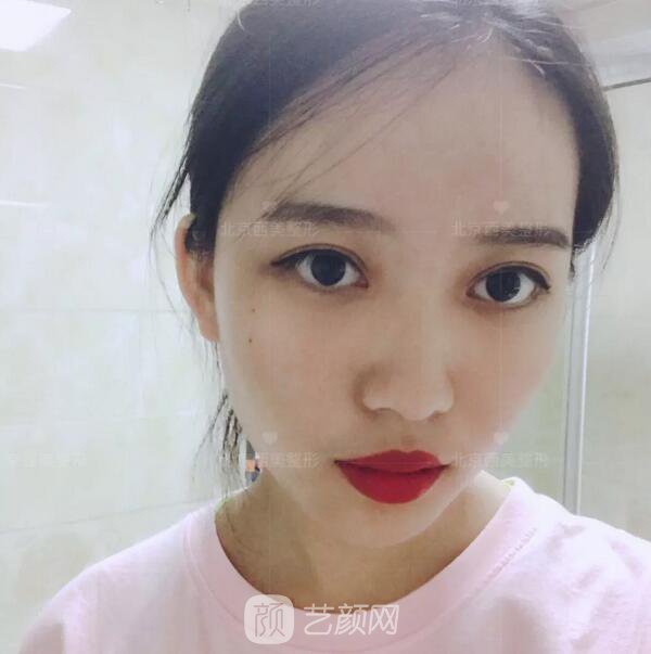 北京西美整形醫(yī)院全切雙眼皮真人案例圖|內(nèi)附恢復(fù)過(guò)程哦~