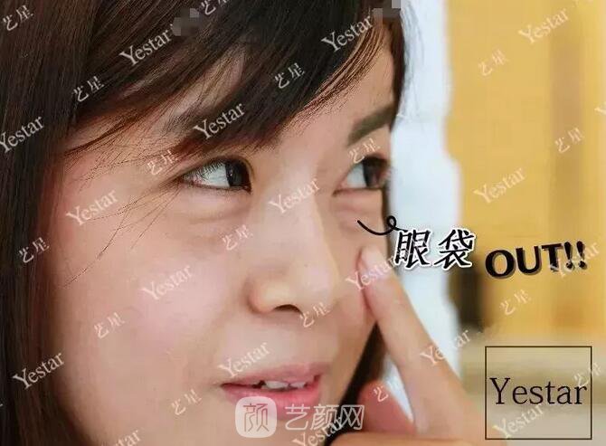 北京藝星整形Yestar分齡祛眼袋真實(shí)案例圖分享哦~