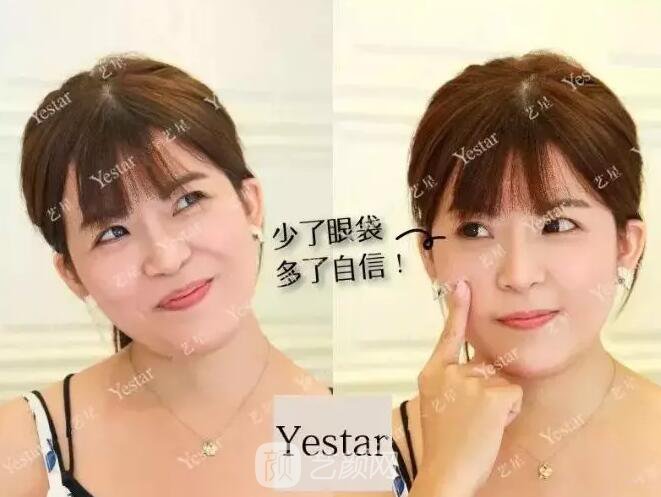 北京藝星整形Yestar分齡祛眼袋真實(shí)案例圖分享哦~