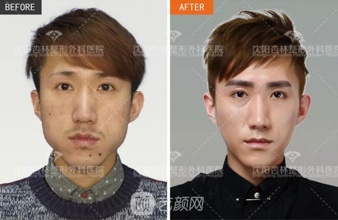 沈陽(yáng)杏林朱石江三維顴骨縮小術(shù)真人案例圖分享