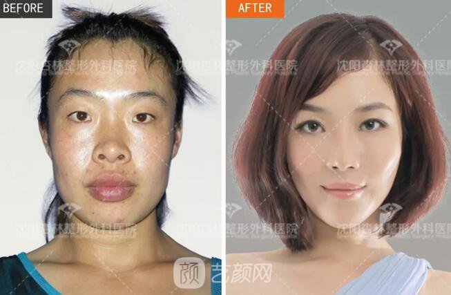 沈陽(yáng)杏林朱石江三維顴骨縮小術(shù)真人案例圖分享