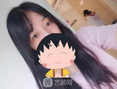 成都嬌點(diǎn)姜宇祿雙眼皮修復(fù)案例，重獲新生！